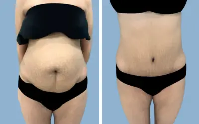 Before and After